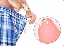 Dương vật chảy mủ xanh, vàng