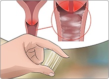 Âm đạo chảy mủ màu xanh, vàng