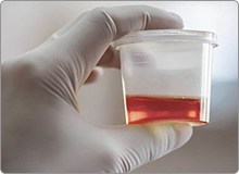 Tiểu buốt ra mủ, tiểu rắt, tiểu ra máu