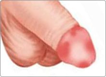 Miệng sáo, bao quy đầu viêm đỏ