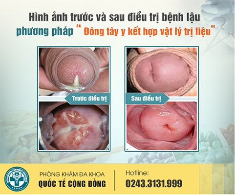 Hình ảnh trước và sau điều trị bệnh lậu
