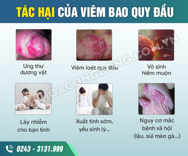 Viêm bao quy đầu mãn tính tái phát nhiều lần có chữa khỏi được không? 