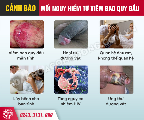 5 tác hại viêm bao quy đầu chớ dại mà coi thường : Phòng Khám Đa ...